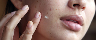 How skin experts are getting rid of dark spots