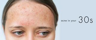 Acne in your 30s: Adult acne causes + solutions