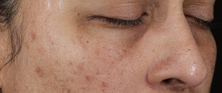 How do dark spots form? Understanding the science behind hyperpigmentation