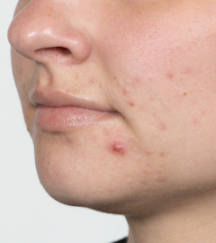 Acne Skin Care – Bioelements